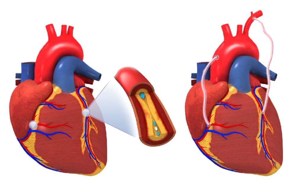 Coronary Artery Bypass Surgery