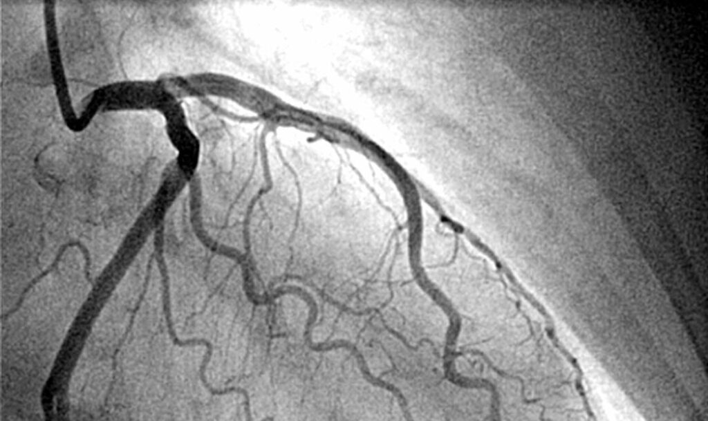 Coronary Angiography