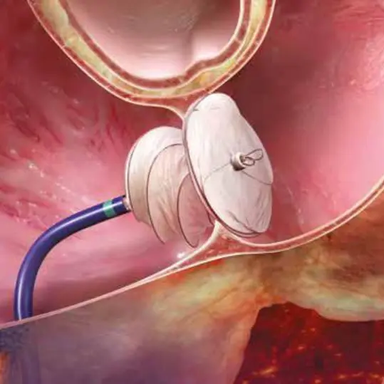 Device Closure treatment in Pune