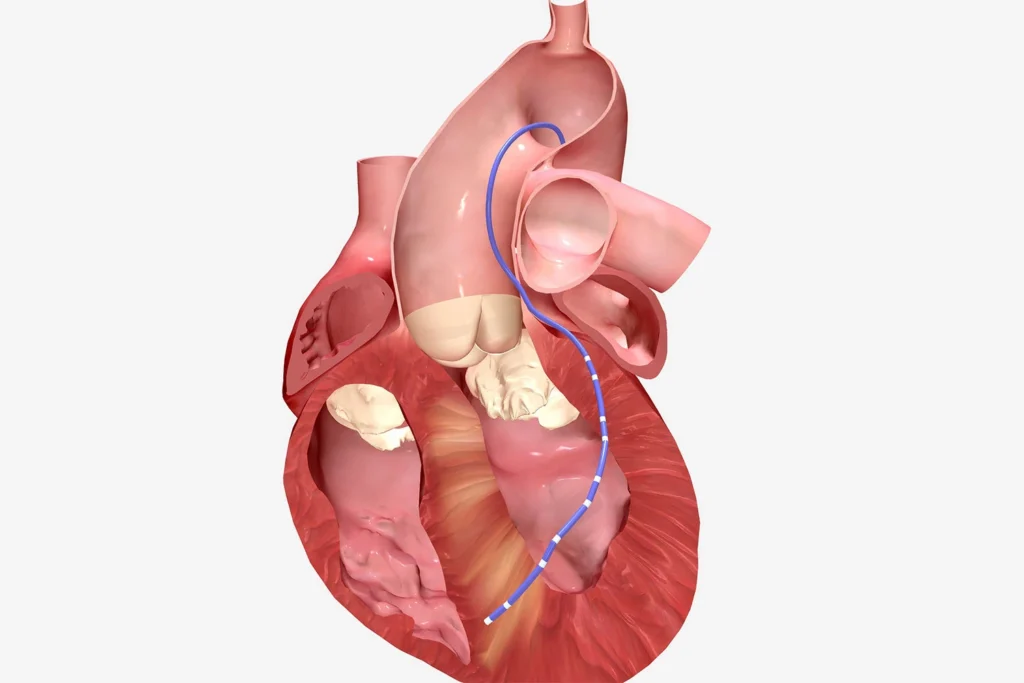 Heart Rhythm Ablation Procedure