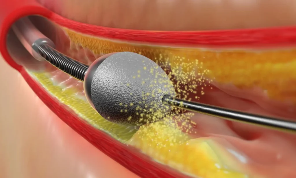 Orbital and Rotational Atherectomy