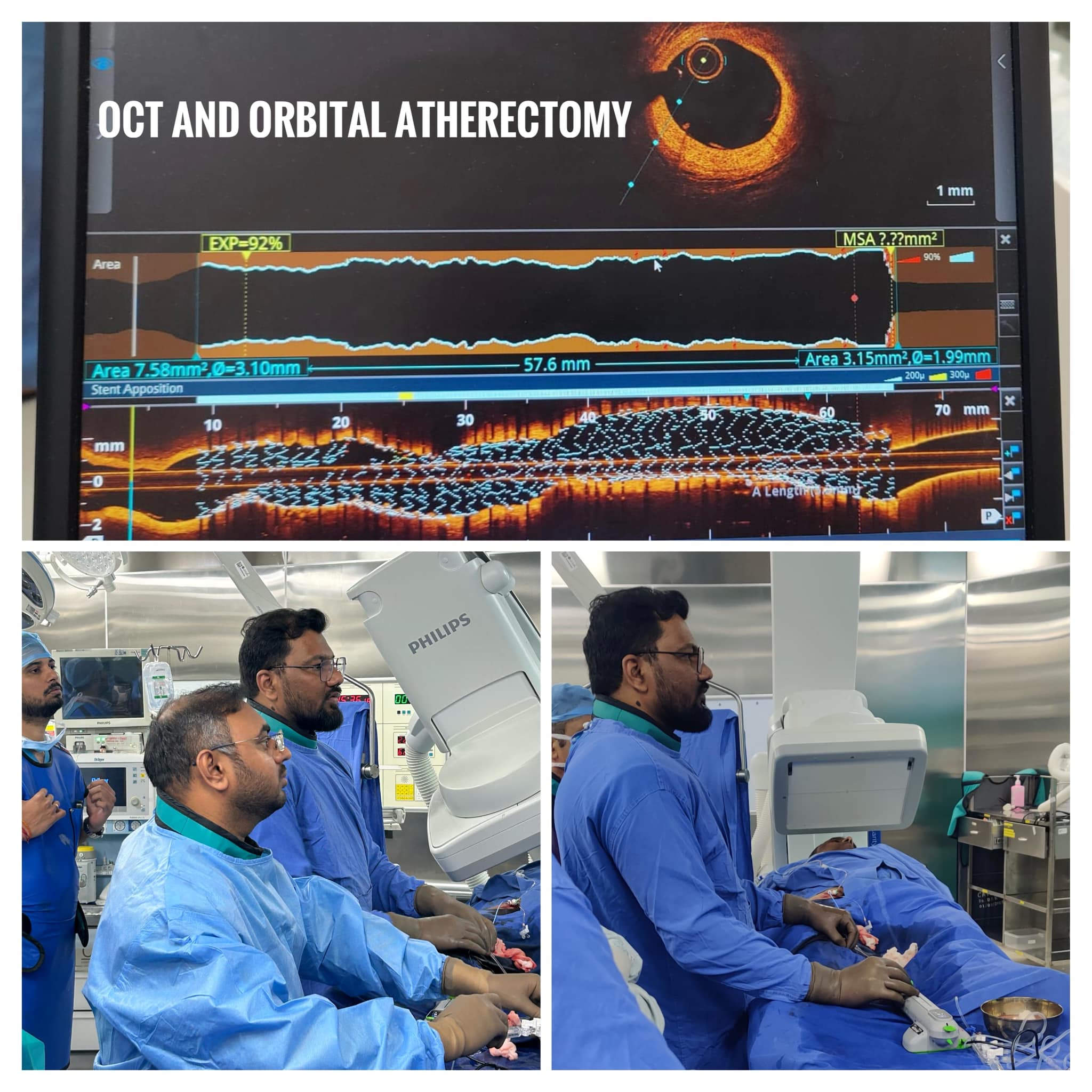 Angioplasty
