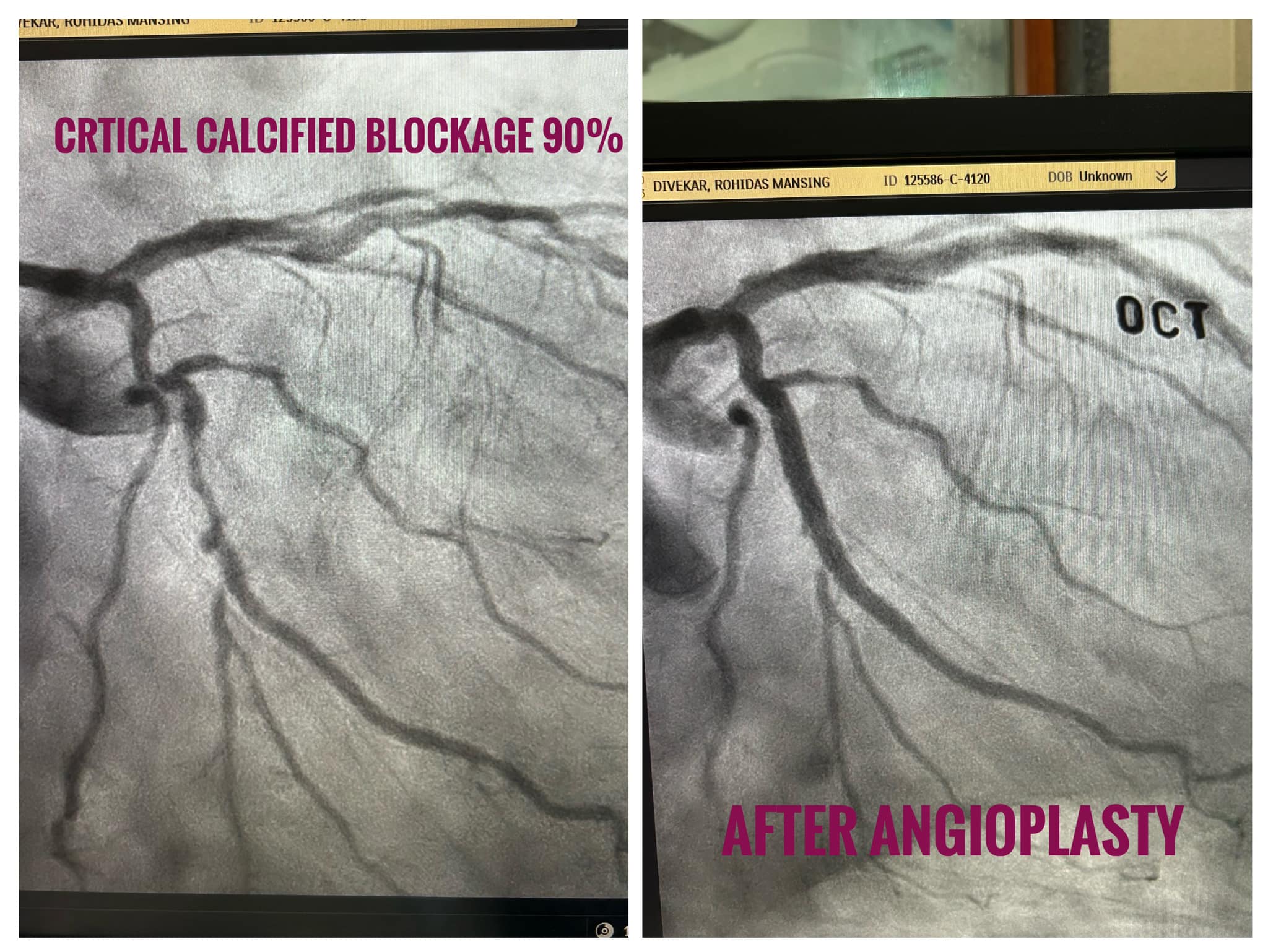Complex Angioplasty