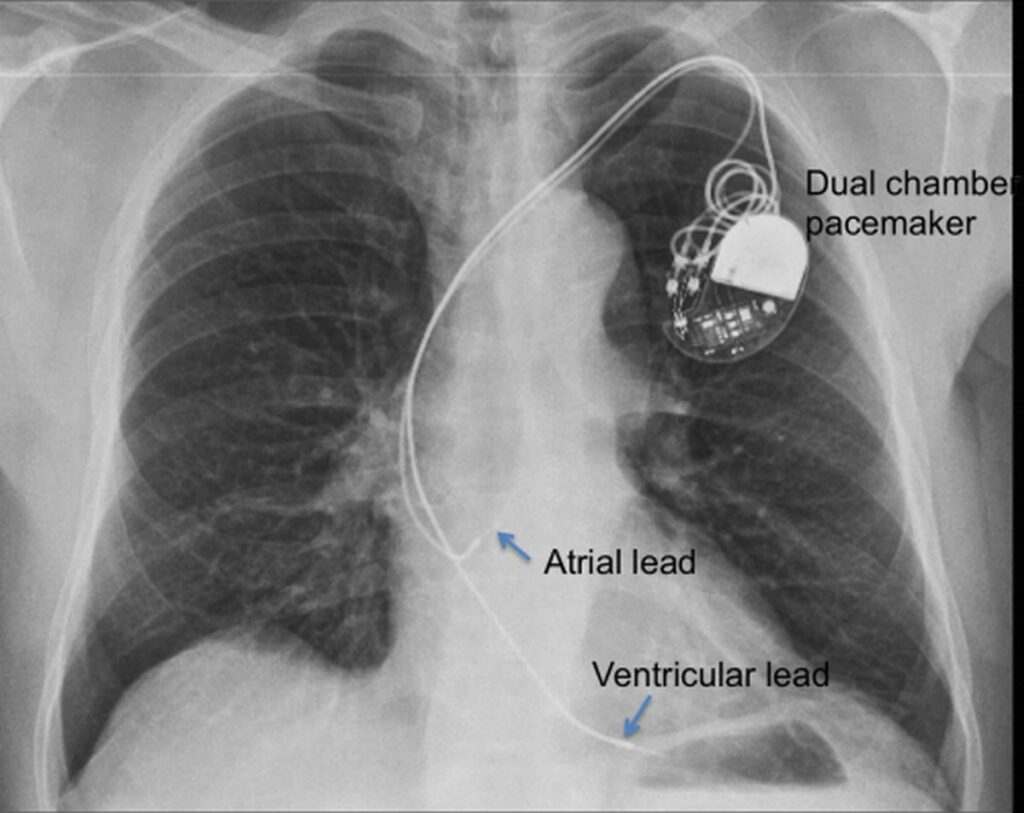 Pacemaker Implantation