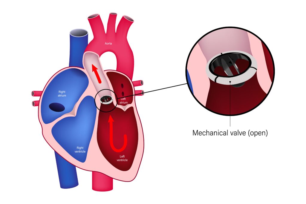 Heart Valve Replacement Surgery